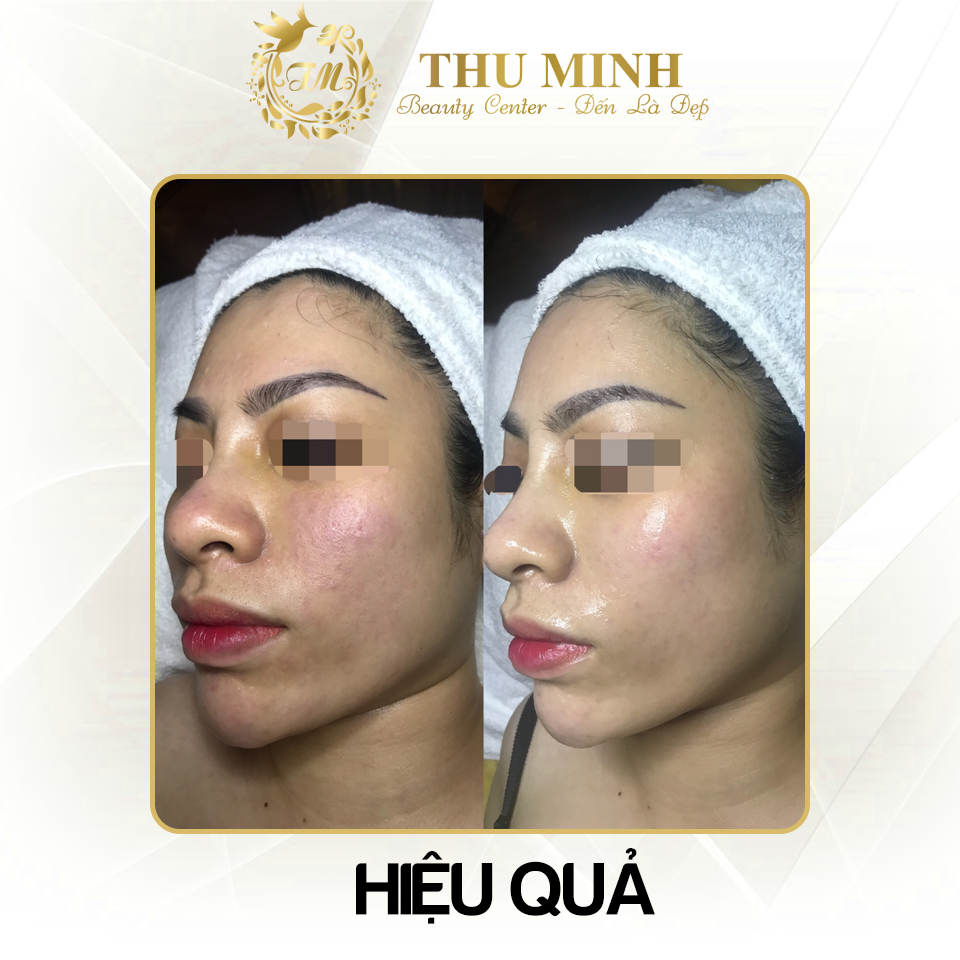 [Cập nhật 2020] Tiêm căng bóng da mặt giá bao nhiêu